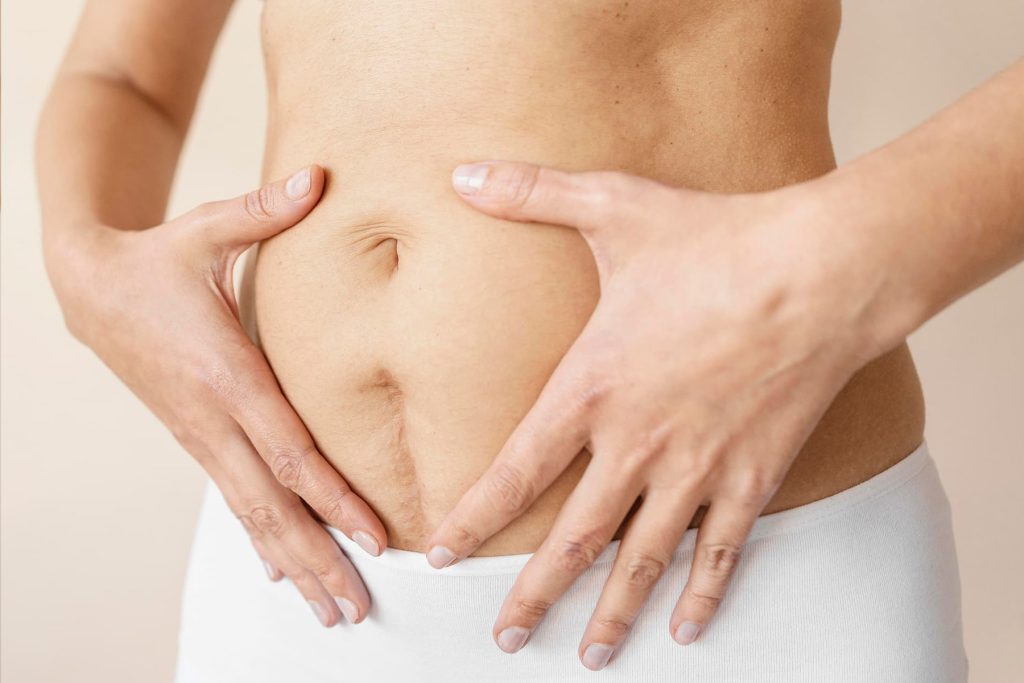 diastasis abdominal